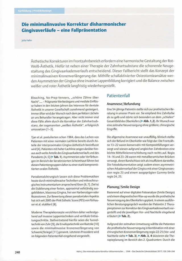 komet-dental-diao-fachbericht-gingivaverlauf-minimalinvasiv image 1