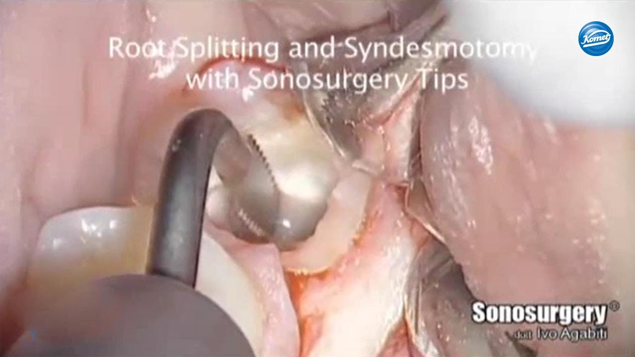 komet-diao-video-extraktion-weisheitszahn-agabiti-chirurgie image 1