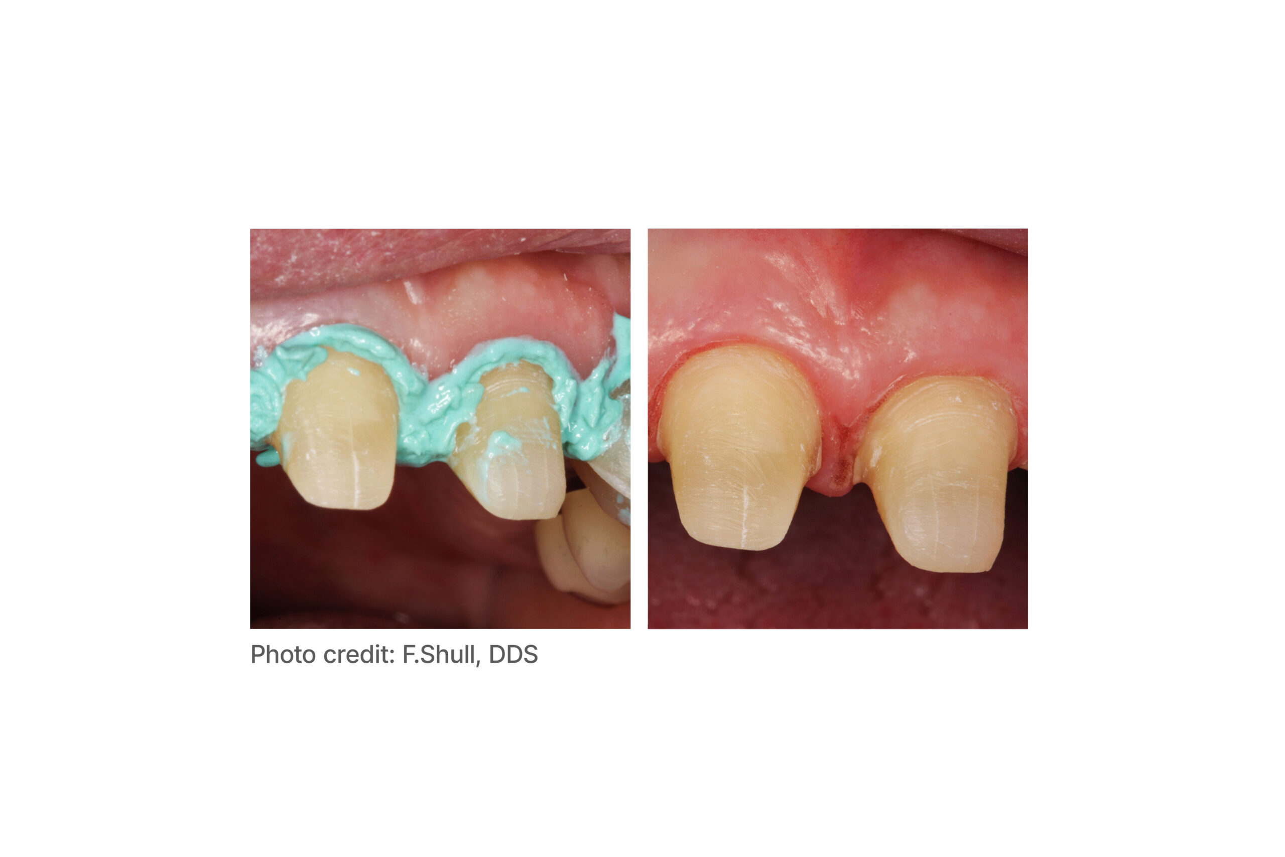 parkell-dryz-blu-retraktionspaste-blau-aluminiumchlorid image 2