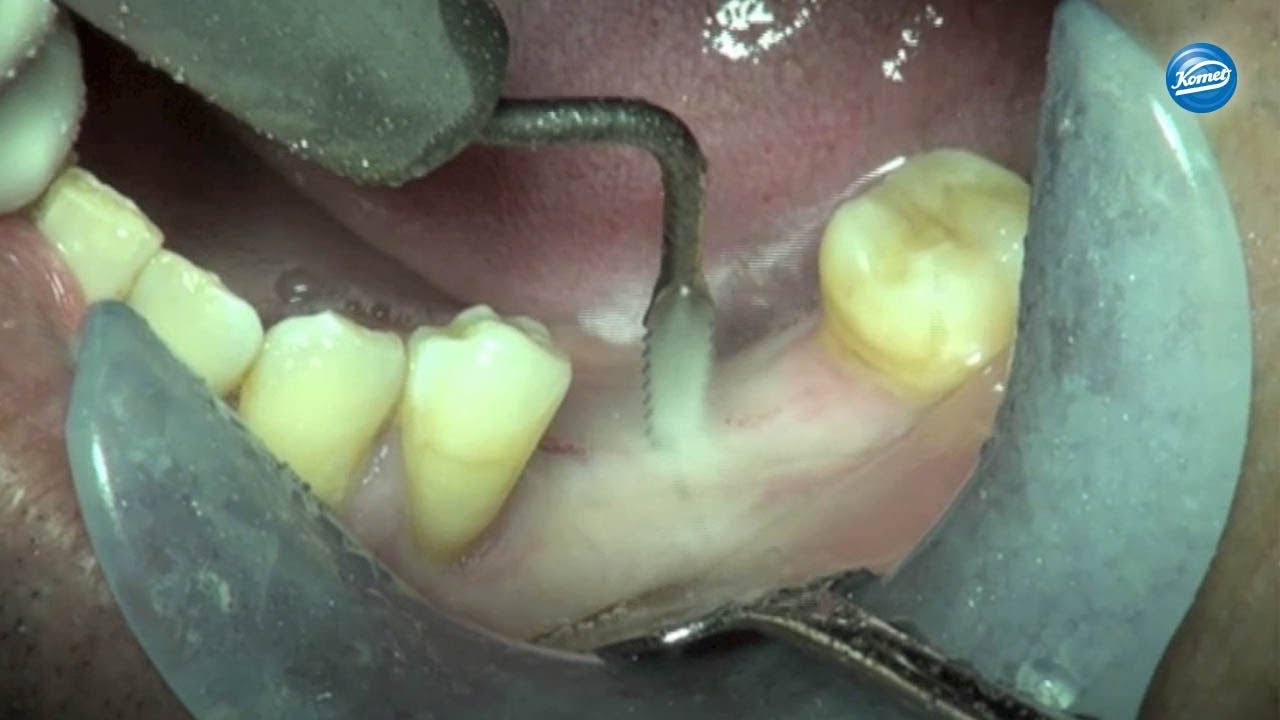 komet-diao-video-alveolarkammspaltung-pelagalli-rom image 1