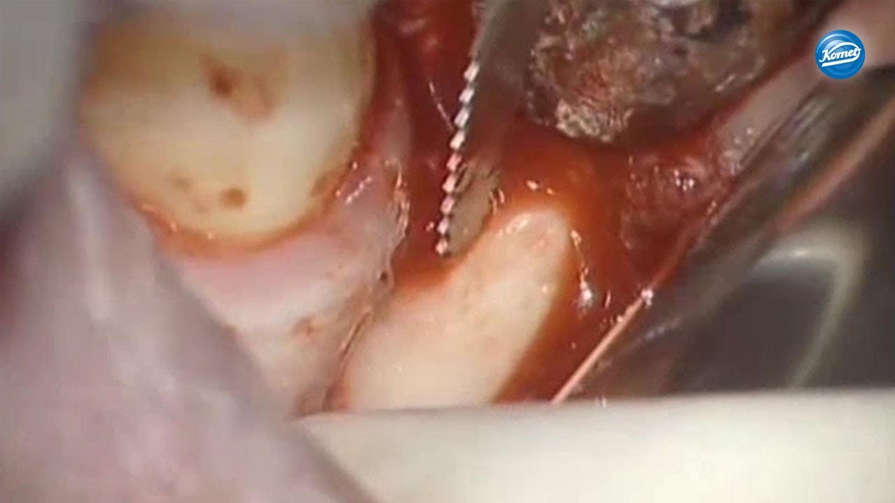 komet-diao-video-intraorale-knochenblock-entnahme image 1