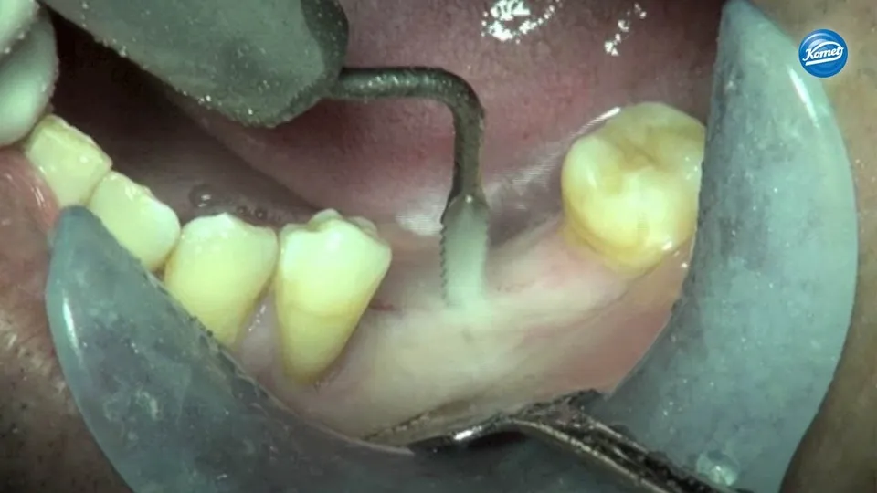 komet-ceradrill-split-crest-flapless-lehrvideo-sonosurgery image 1