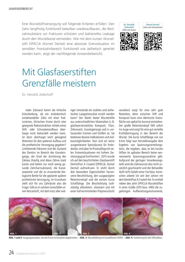 komet-cerapost-fb-glasfaserstift-wurzelstift-09-2017 image 1