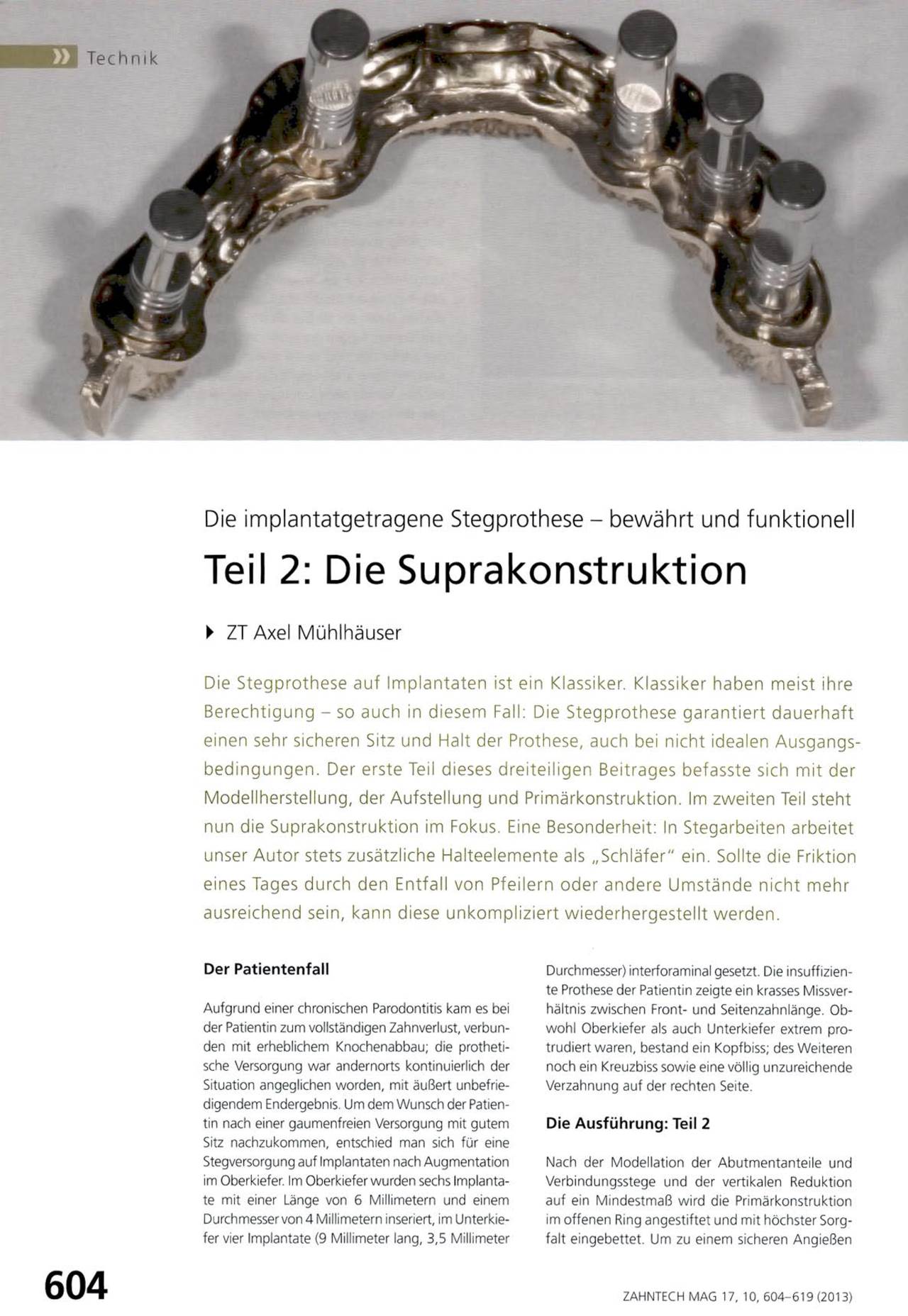 komet-dental-diao-fachbeitrag-suprakonstruktion-stegprothese image 1