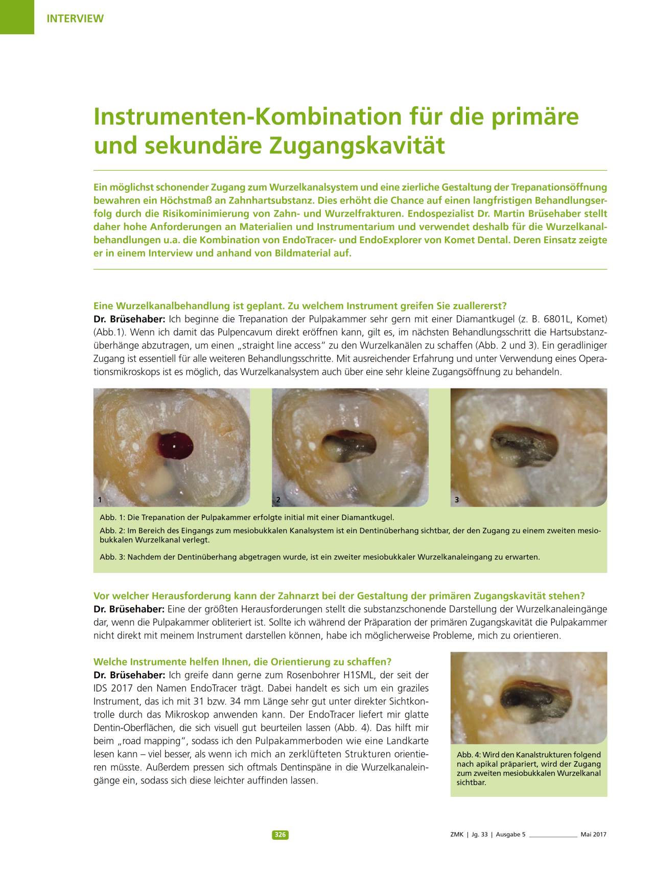 komet-dental-diao-fachbericht-zugangskavit-t-endo image 1