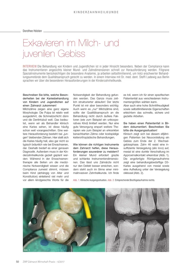 komet-diao-fachbericht-exkavieren-milchgebiss-06-2017 image 1