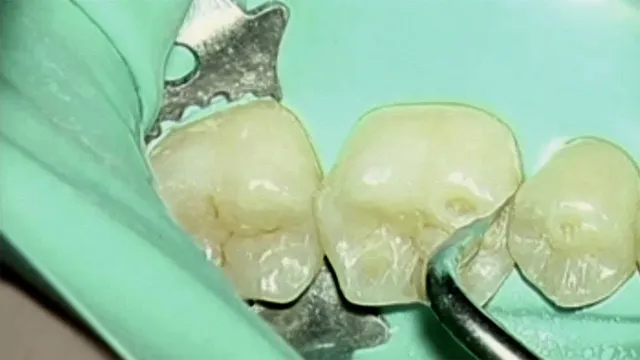 komet-dental-sonicline-video-kavit-tenpr-paration-agabiti-konservierend image 1
