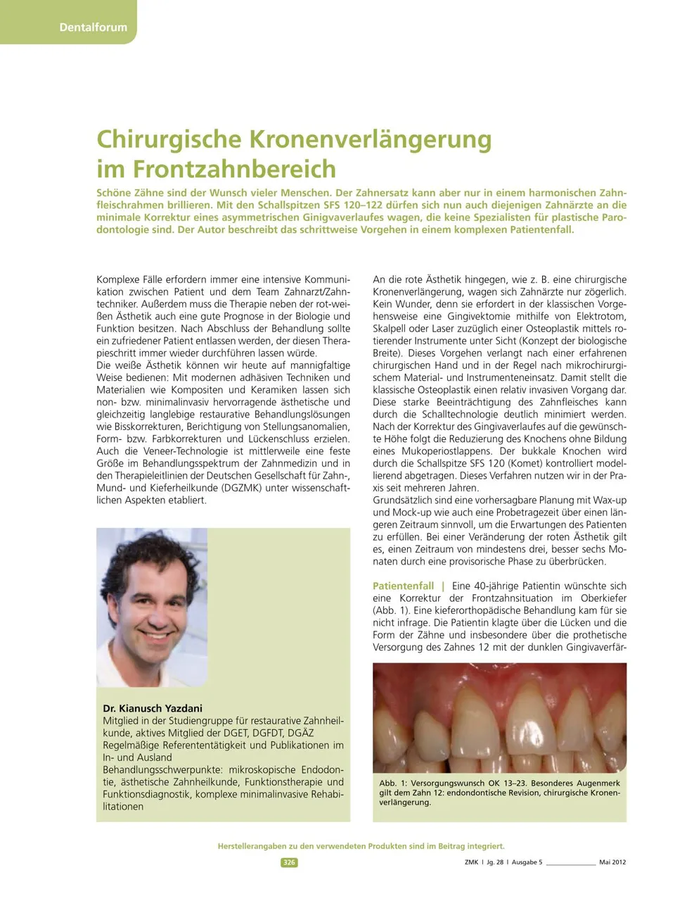 komet-dental-ceradrill-fb-kronenverl-ngerung-frontzahn image 1