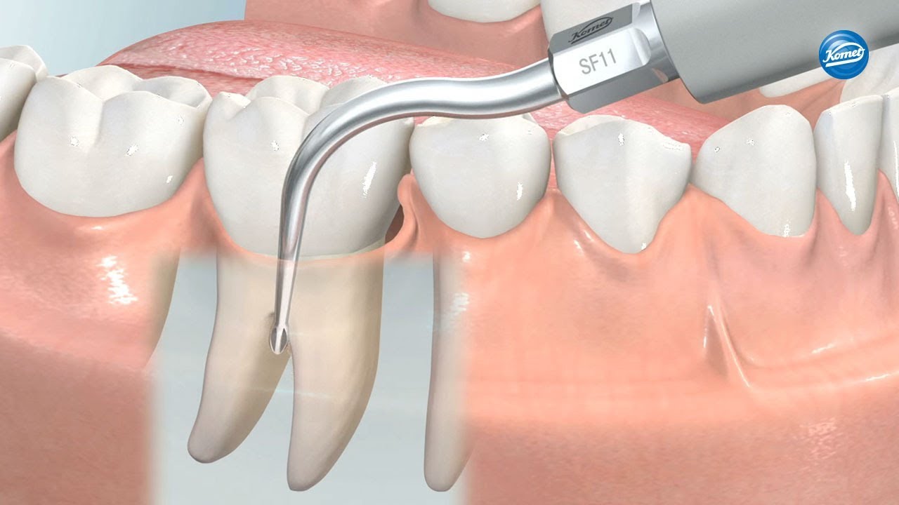 komet-dental-sonicline-video-parodontalbehandlung-schall image 1