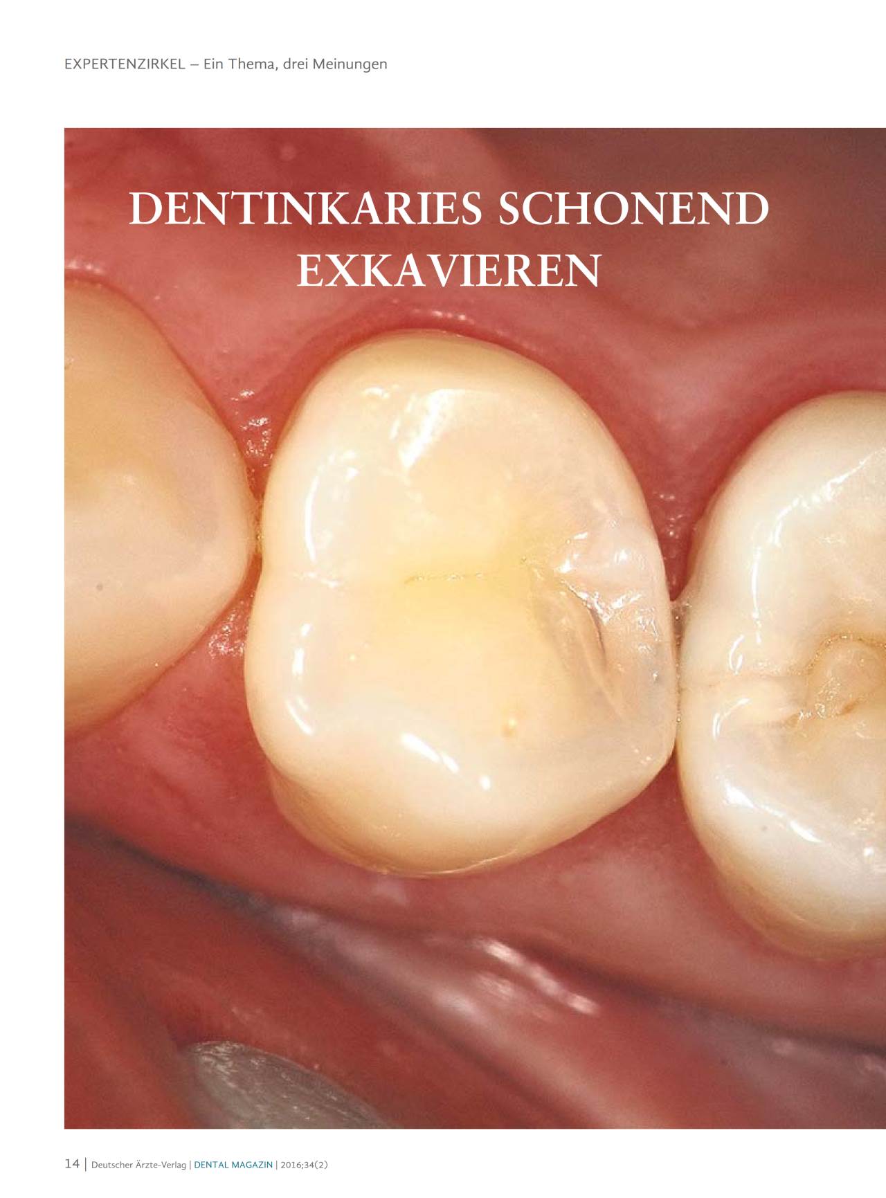 komet-diao-diamantbohrer-dentin-exkavation-steril image 1