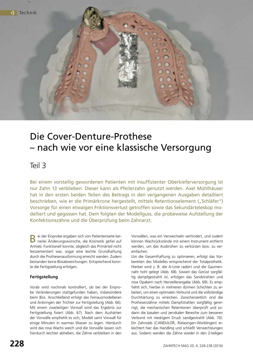 komet-shax-cover-denture-prothese-teil-3-fachbericht image 1