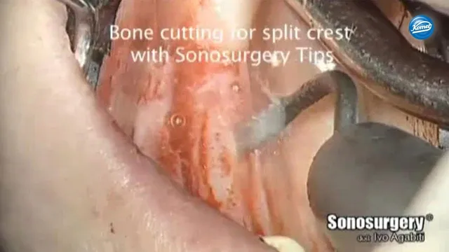 komet-dental-diao-video-krestalschnitt-dr-agabiti image 1