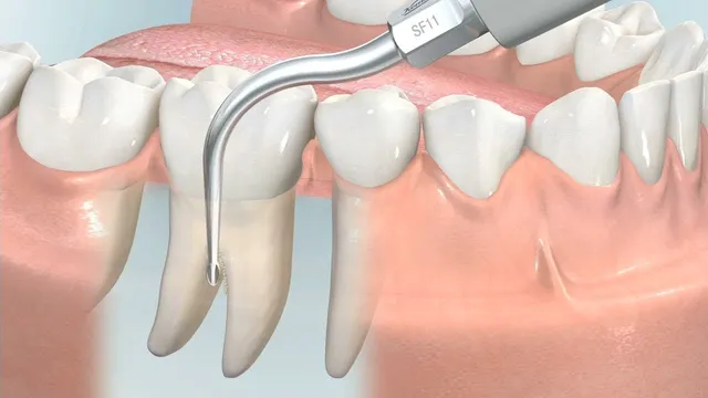 komet-dental-diao-video-wurzeloberfl-chenbehandlung image 1