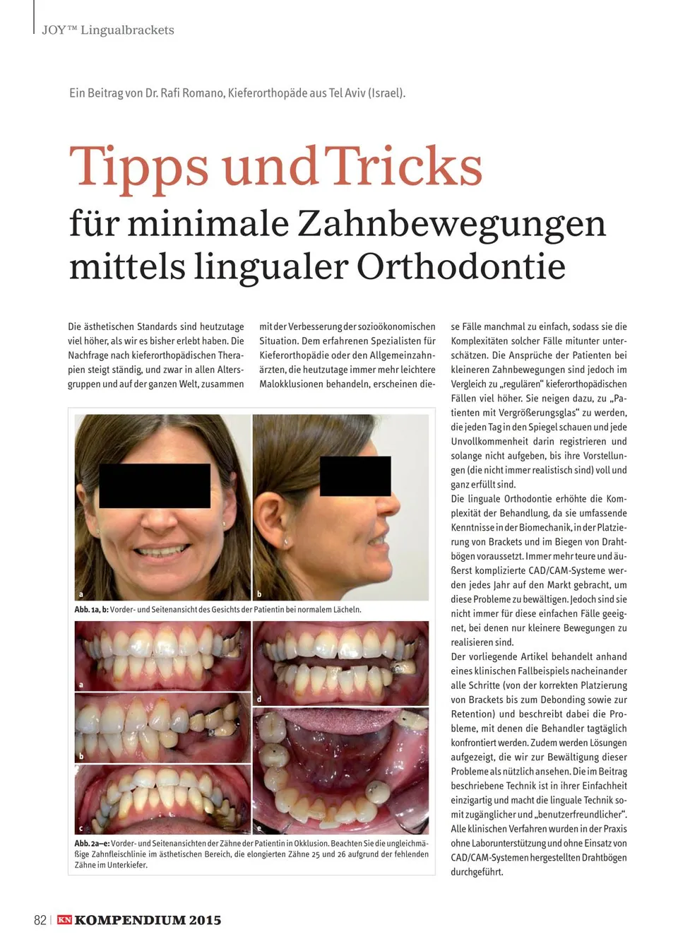 komet-sonicline-linguale-orthodontie-fachbericht-zahnbewegungen image 1