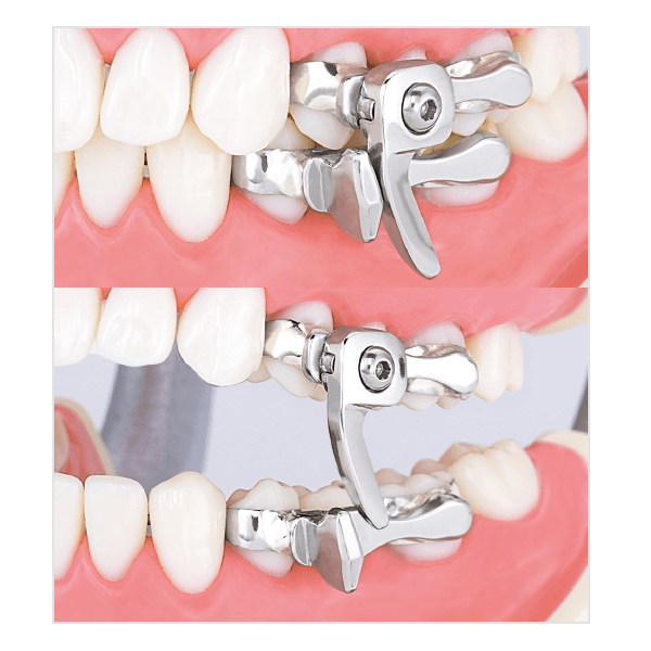 forestadent-fma-advancer-klasse-ii-starr-unterkiefer-vorschub image 2