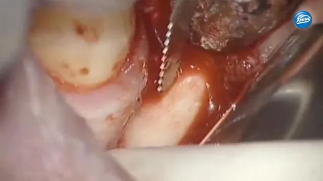 komet-ceradrill-schallspitzen-video-knochenblock-implantologie image 1
