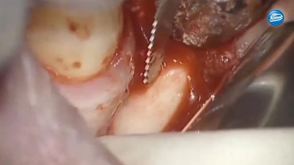 komet-ceradrill-schallspitzen-video-knochenblock-implantologie image 1