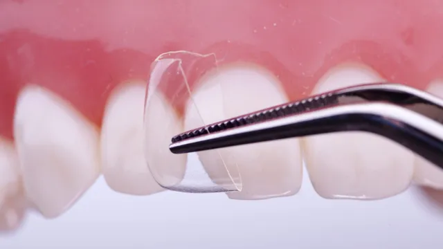 luxator-restorative-coform-matrize-komposit-klasse-iv-transparent image 1