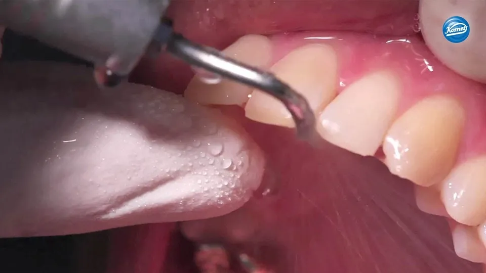komet-dental-sonicline-video-sonostripping-interproximal image 1