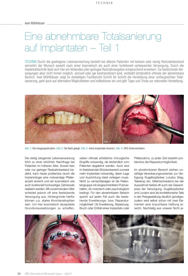 komet-ceradrill-totalsanierung-implantate-fachbericht-teil-1-3 image 1