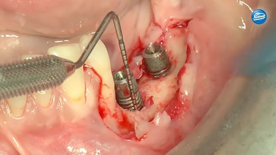komet-ceradrill-periimplantitis-fr-se-hartmetall-extralang image 1