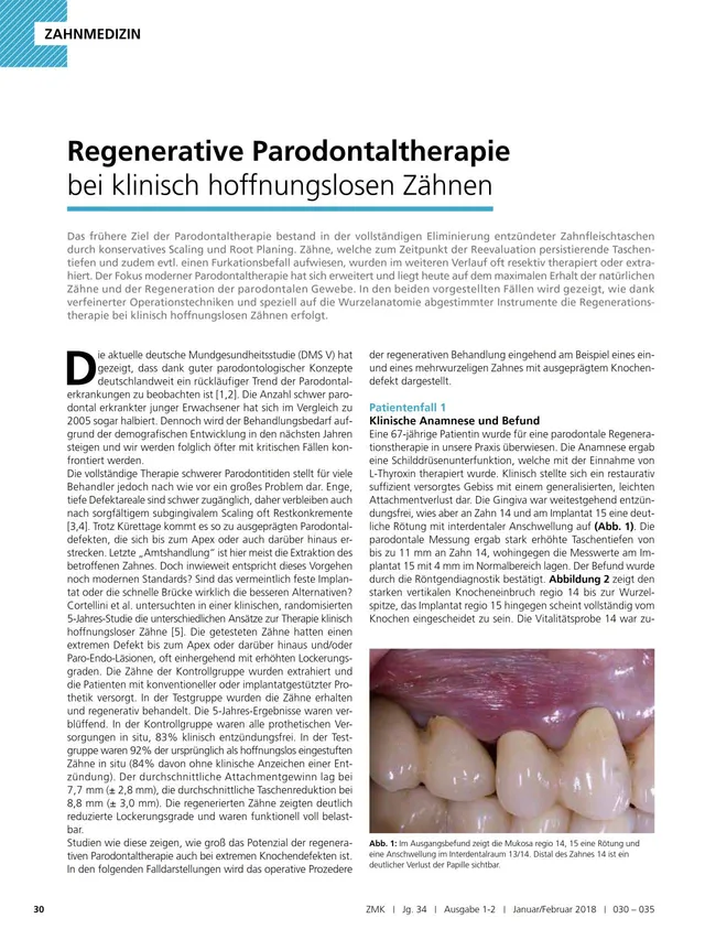 komet-sonicline-fachbericht-regenerative-parodontaltherapie image 1