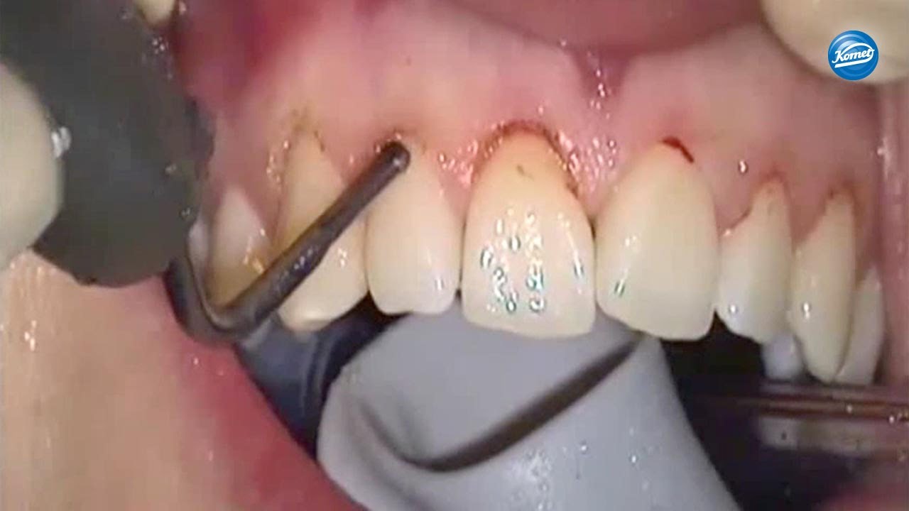 komet-dental-ceradrill-video-chirurgische-kronenverl-ngerung image 1