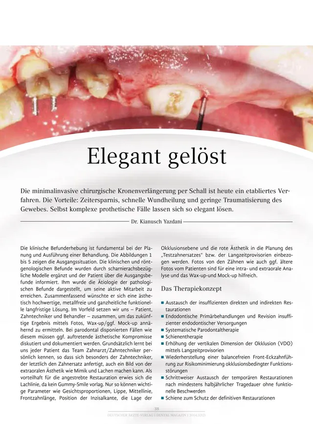 komet-dental-ceradrill-fachbericht-kronenverl-ngerung-schall image 1