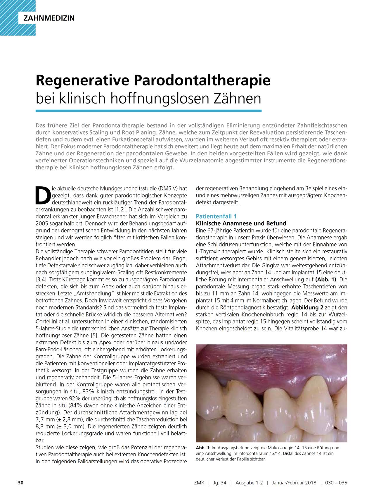 komet-sonicline-fachbericht-regenerative-parodontaltherapie image 1