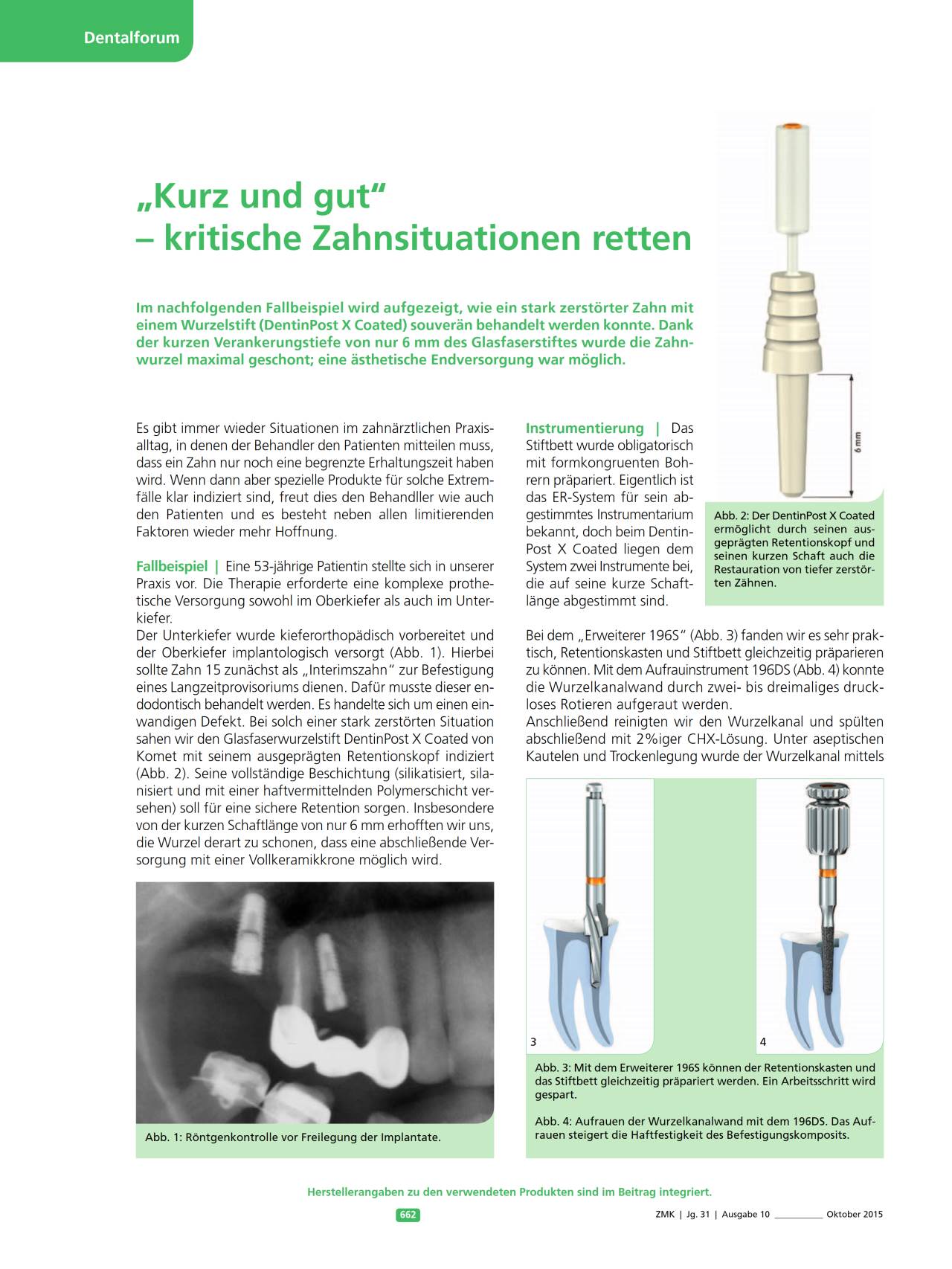 komet-dental-diao-dentinpost-x-coated-fachbericht-wurzelstift image 1