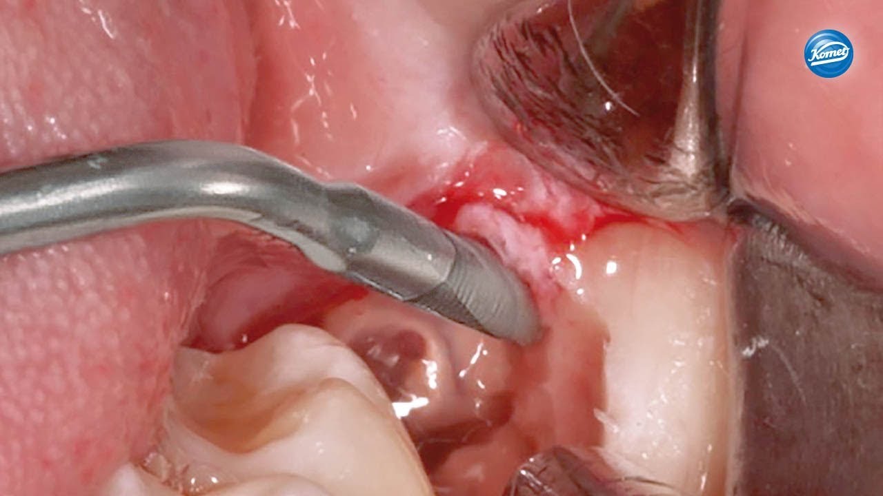 komet-ceradrill-video-eckzahn-extraktion-sfs90 image 1