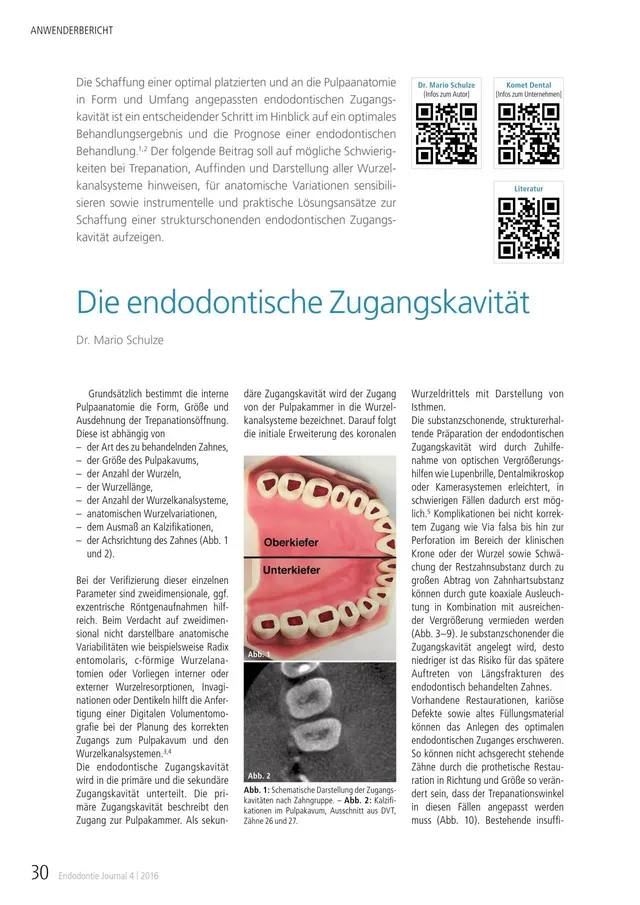 komet-fq-fachbericht-endodontische-zugangskavit-t-trepanation image 1