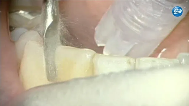 komet-dental-sonicline-ipr-video-kieferorthop-dische-behandlung image 1