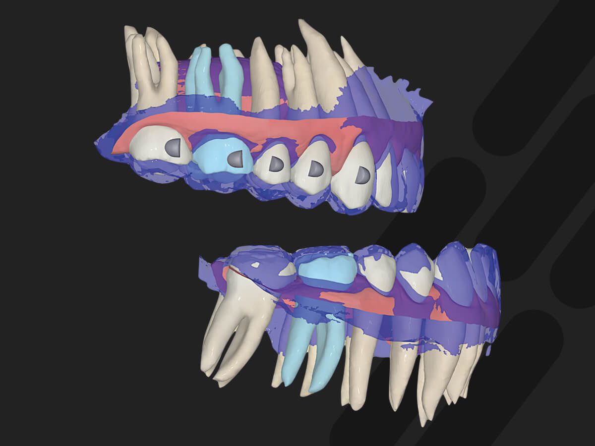 forestadent-fas-aligner-system-aligner-schiene-mit-arc-of-closure image 3
