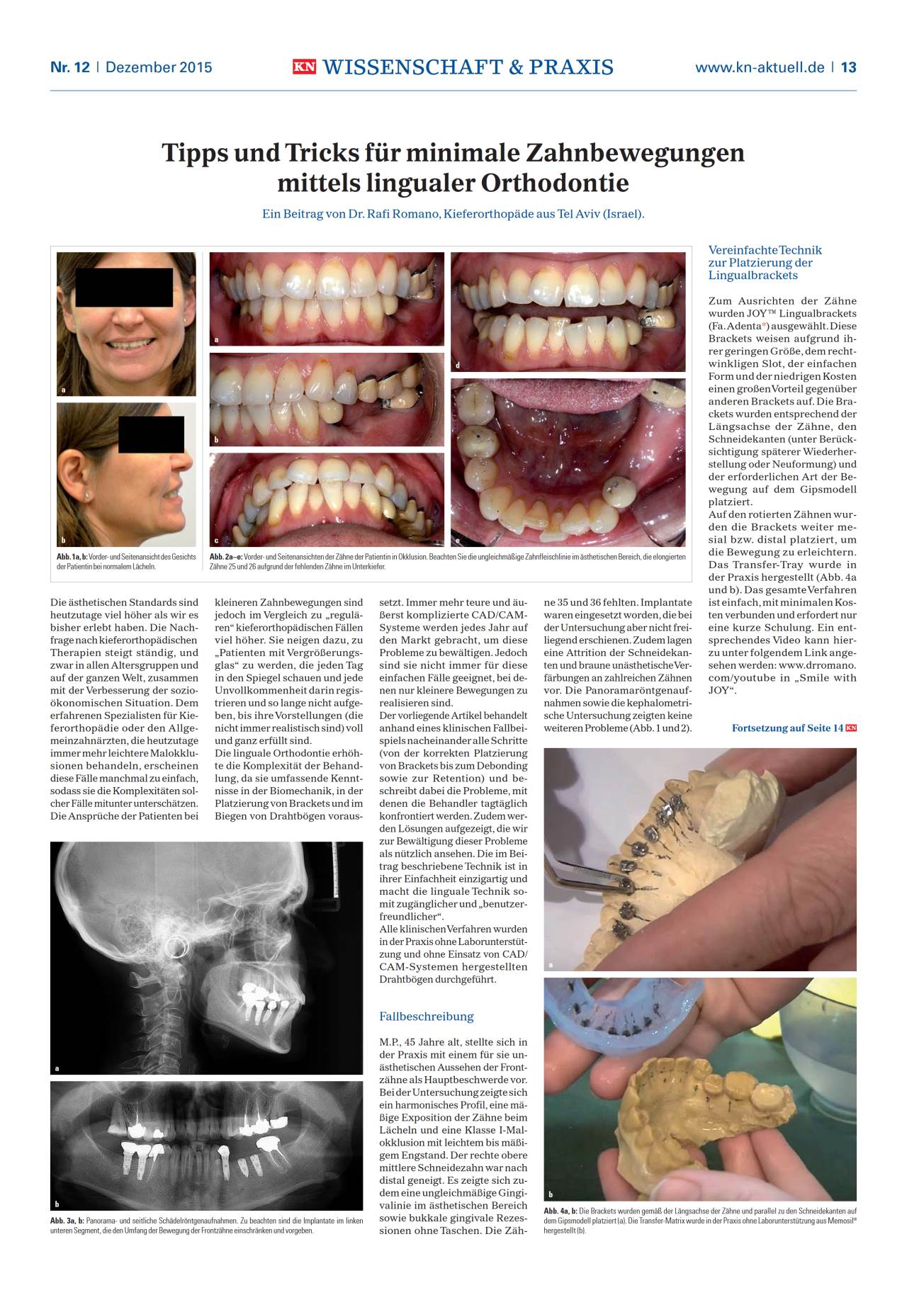 komet-dental-sonicline-spitze-linguale-orthodontie image 1