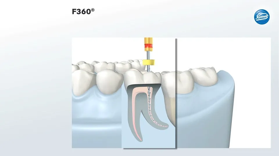 komet-f360-animation-video-wurzelkanal-aufbereitung image 1