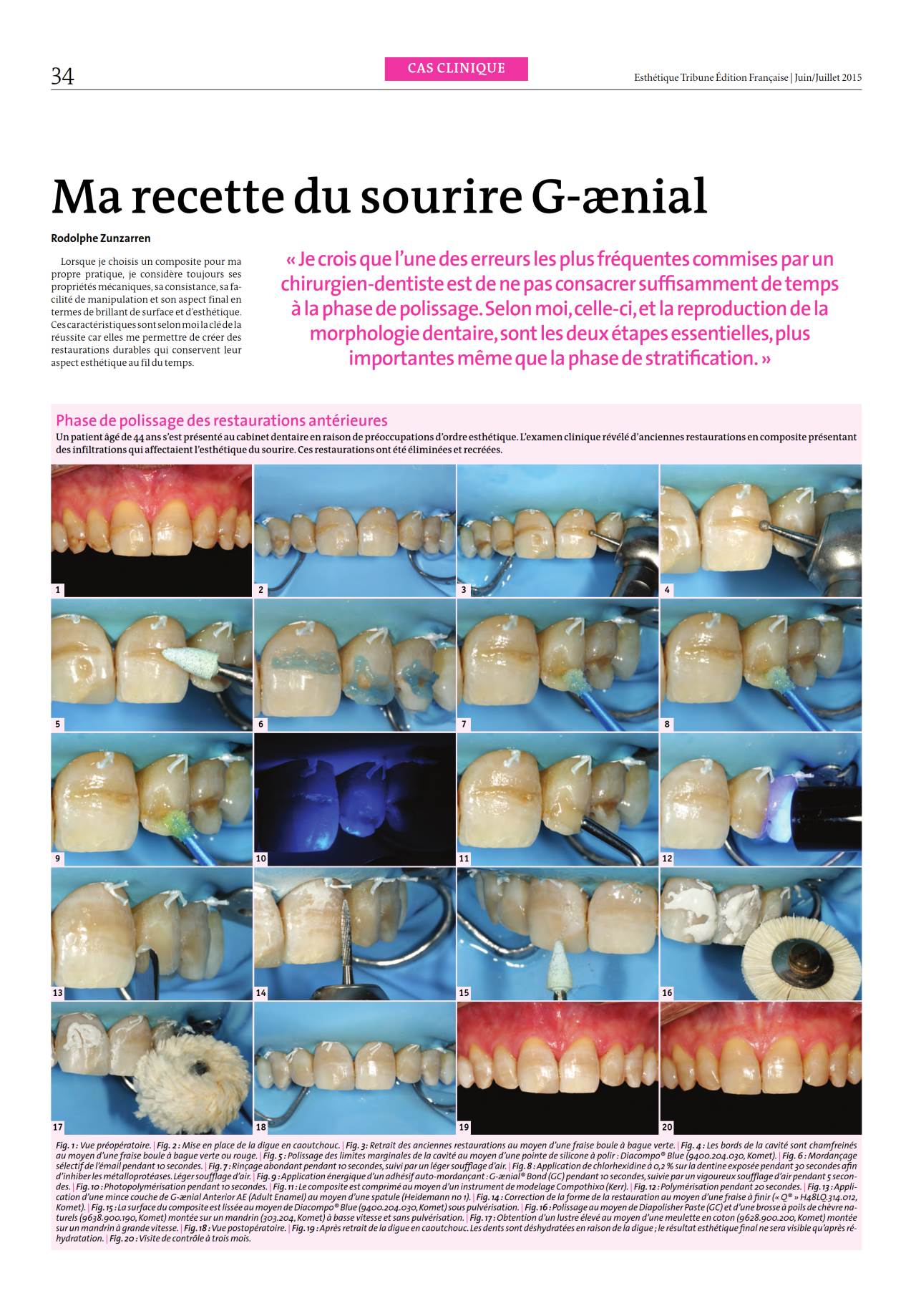 komet-dental-cerapost-fachbericht-politur-restaurationen-anterior-posterior image 1