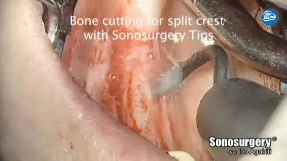 komet-dental-ceradrill-video-split-crest-agabiti-implantologie image 1