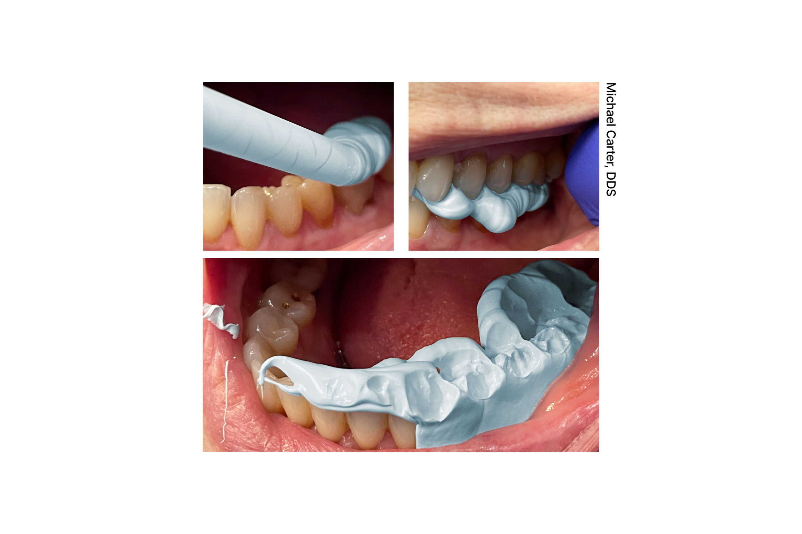 parkell-blu-mousse-bissregistrierung-vps-shore-90-pr-zisionsabformung image 2