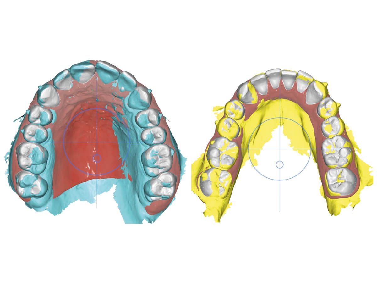 forestadent-fas-aligner-system-digitale-behandlungsplanung-wizard image 8