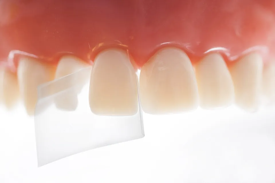 luxator-restorative-proxypal-matrizenband-frontzahn-diastema image 1