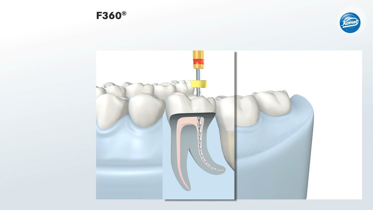 komet-f360-animation-video-wurzelkanal-aufbereitung image 1