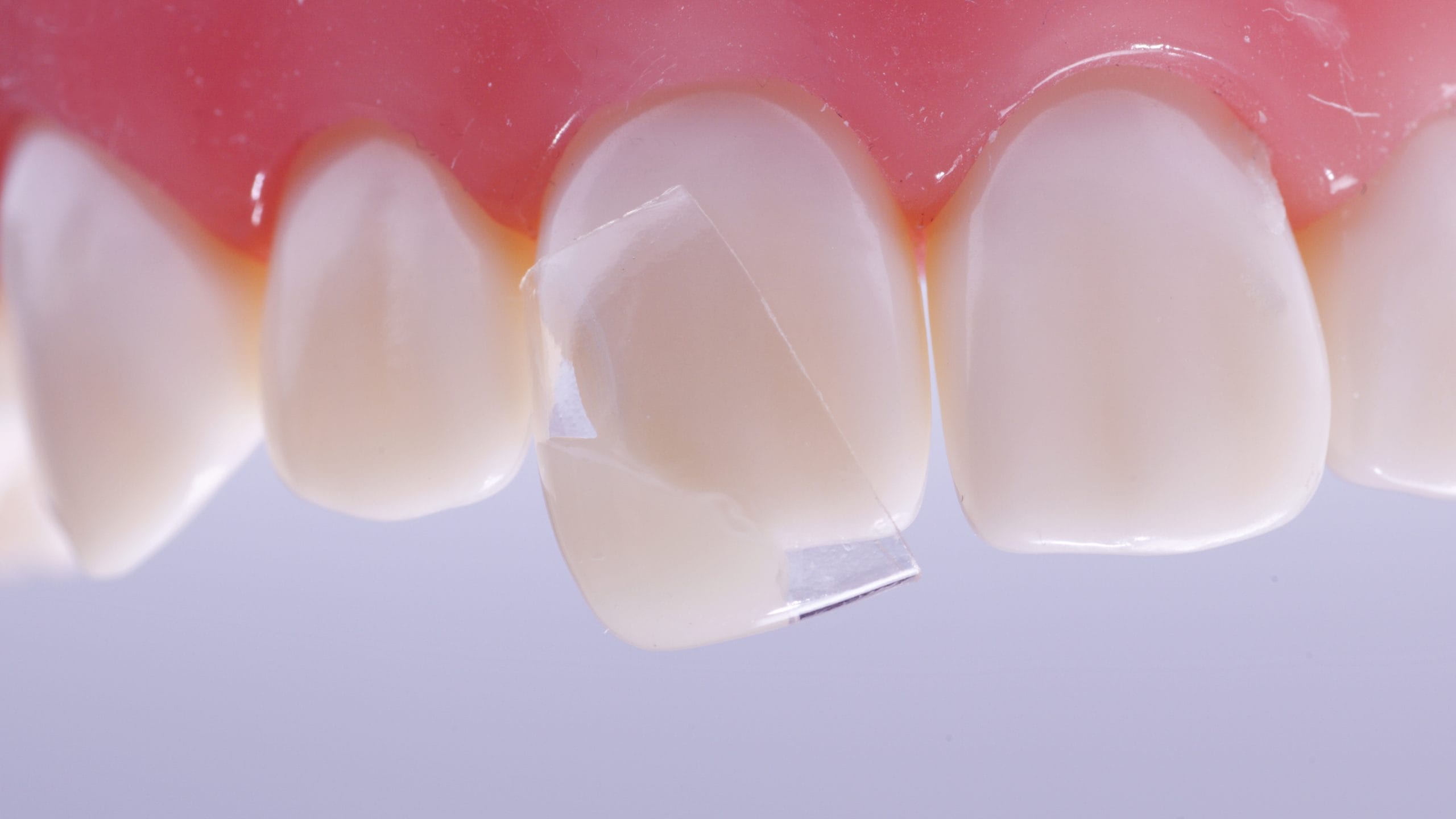 luxator-restorative-coform-matrize-komposit-klasse-iv-transparent image 3
