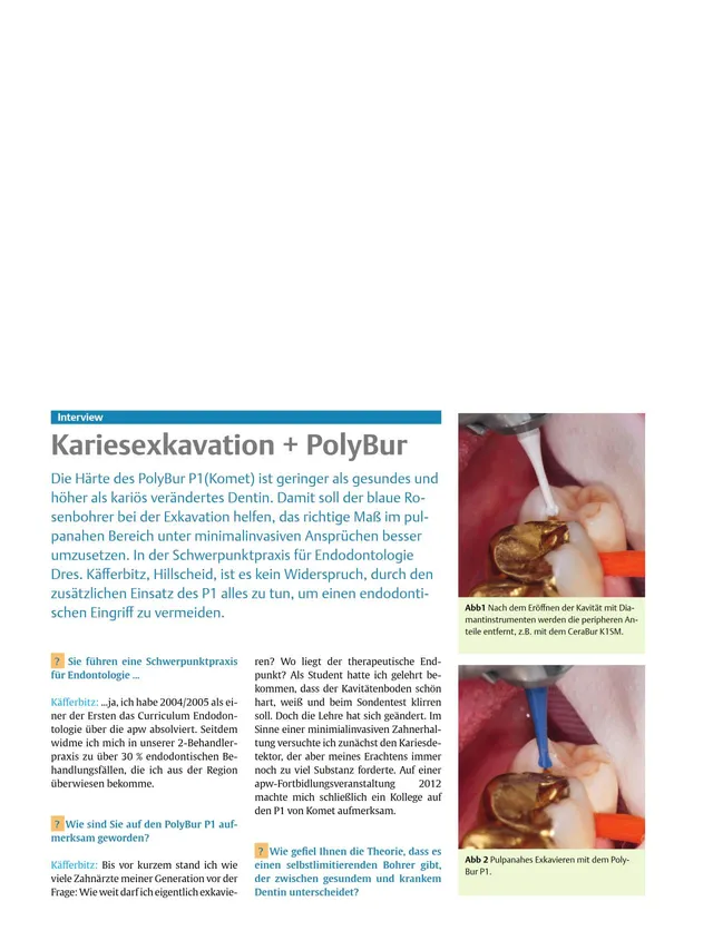 komet-polybur-p1-fachbericht-kariesexkavation image 1