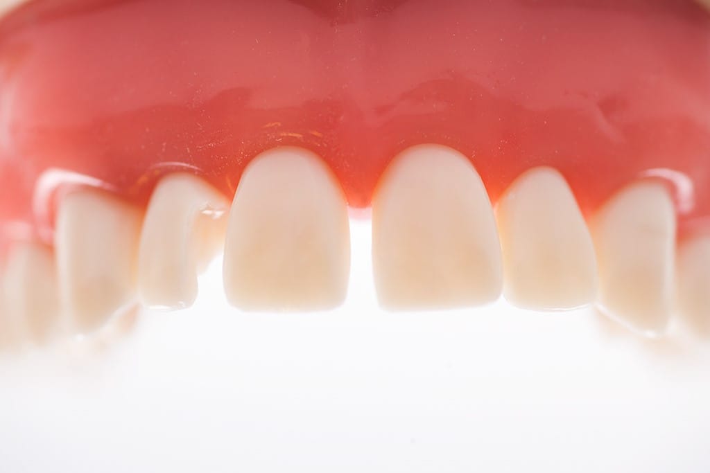 luxator-restorative-proxypal-matrizenband-frontzahn-diastema image 2