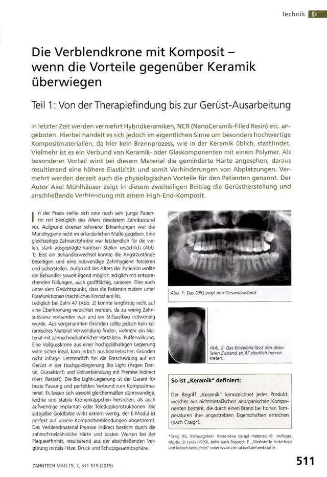 komet-dental-ceracut-fachbericht-verblendkrone-komposit image 1