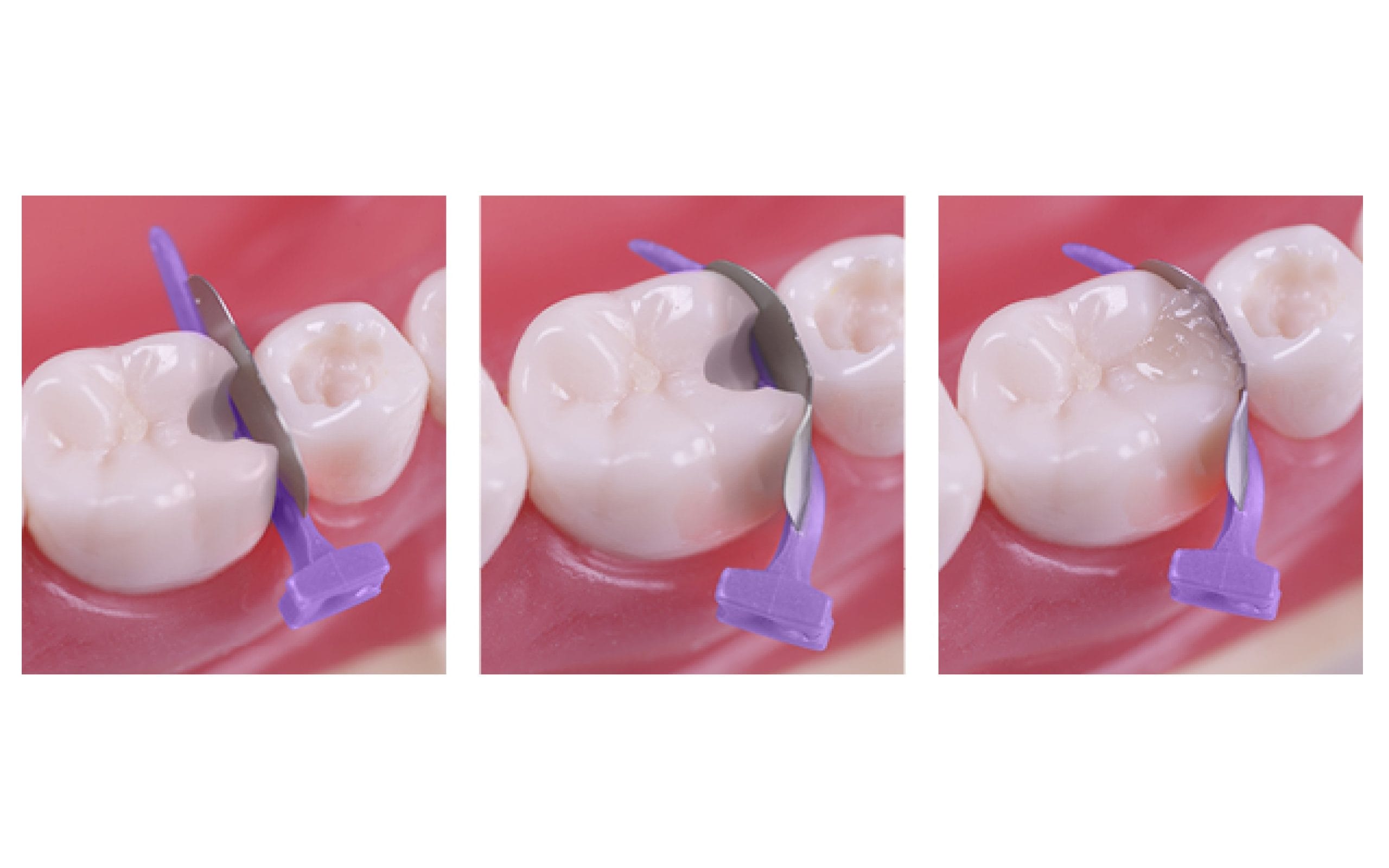 luxator-fendermate-temp-teilmatrize-keil-provisorisch image 5