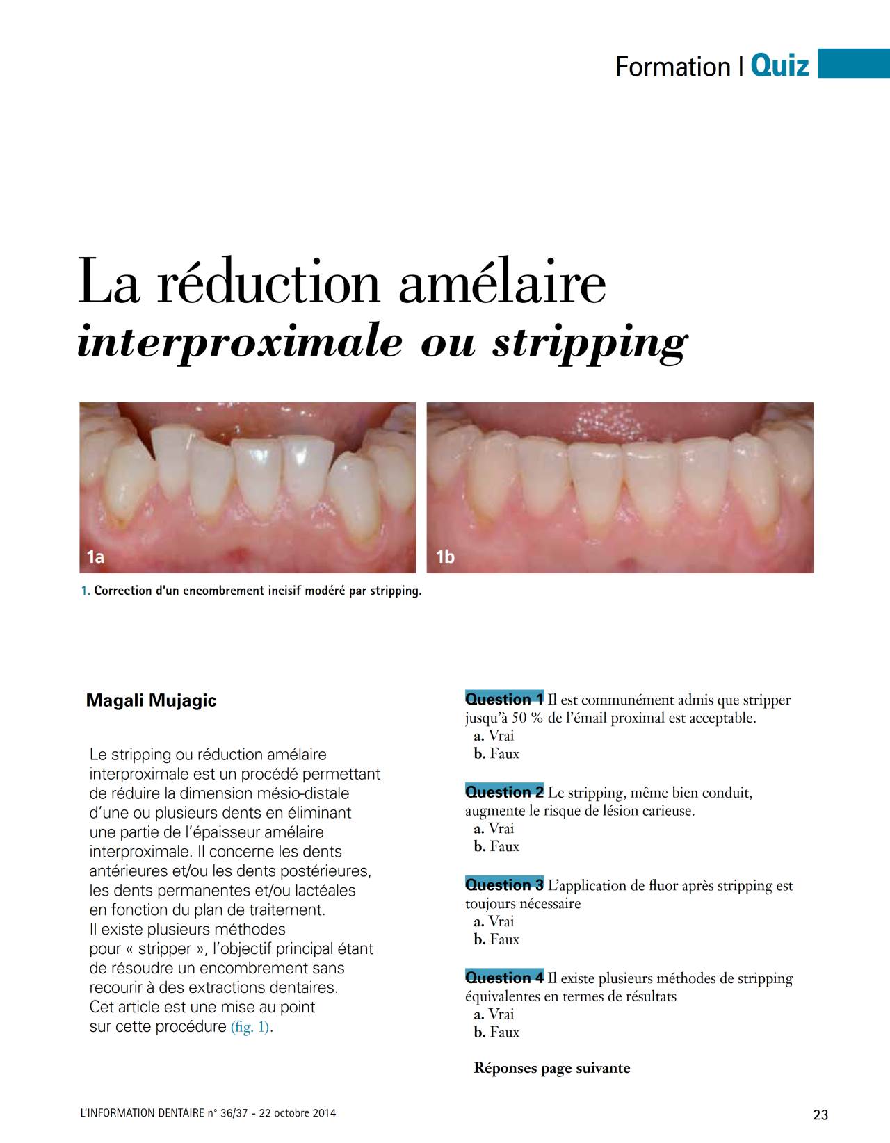 komet-dental-diao-quiz-schmelzreduktion-fachbericht-dr-mujagic image 1