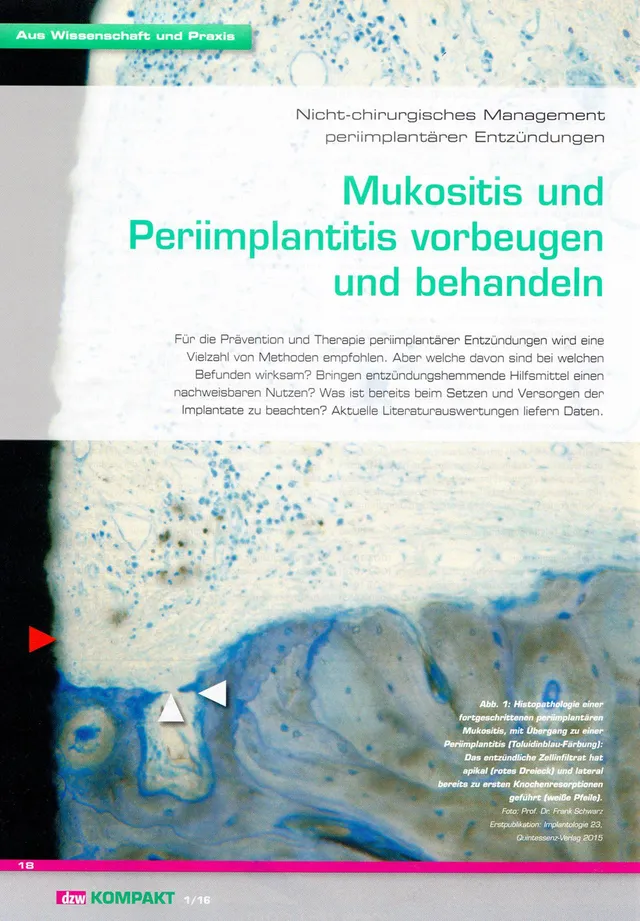 komet-dental-ceradrill-implantatbohrer-periimplantitis-set image 1