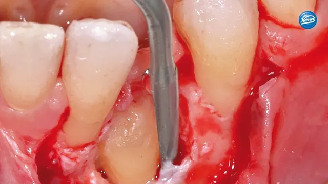 komet-dental-sonicline-video-schallinstrument-sfs90m-sfs90d image 1